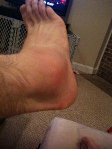 What the ankle looks like today.
